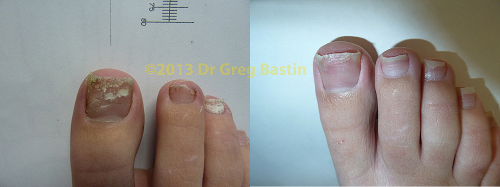 fungal nail laser treatment brighton