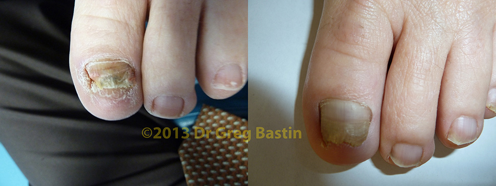 podiatrist melbourne nail fungus