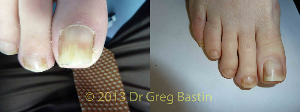 best fungal nail treatment