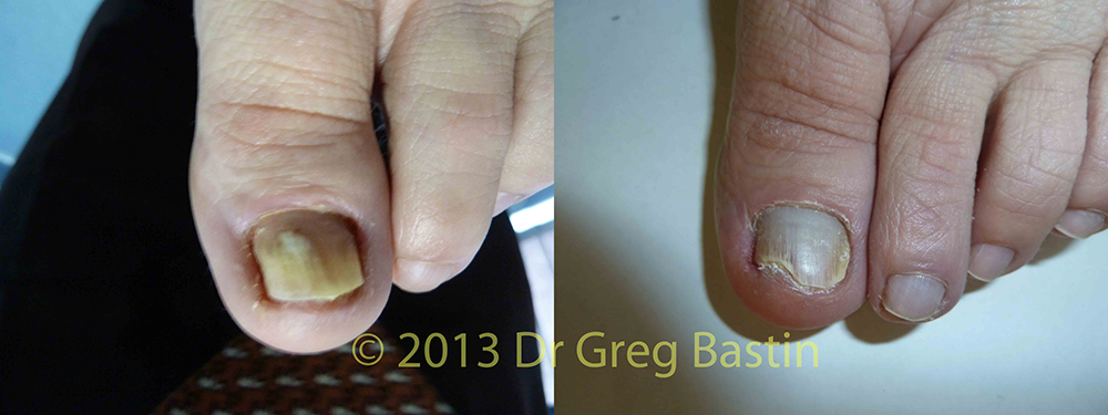 most effective treatment for toenail fungus