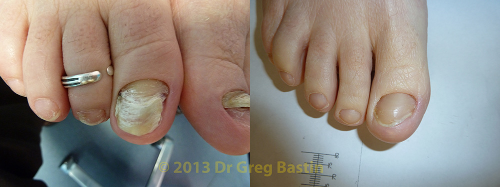 laser treatment of nail fungus