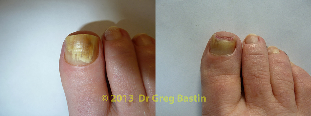 laser treatment for nail fungus