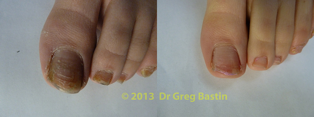 Fungal Nail Treatment