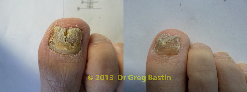 Nail Fungus Treatment